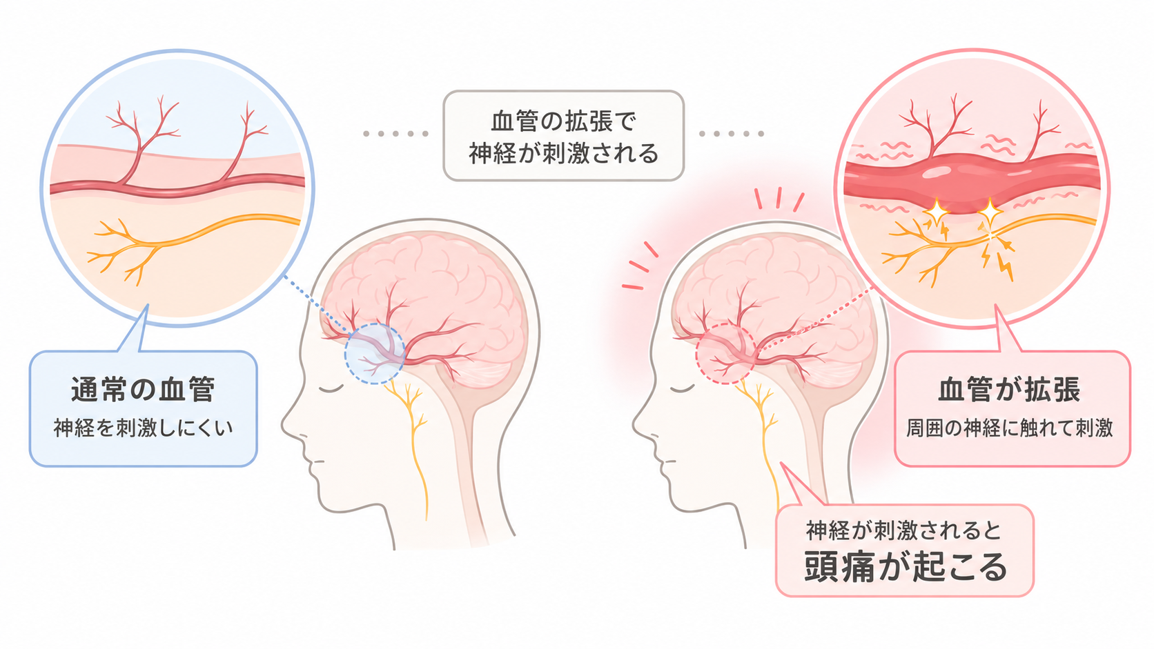 頭痛の記事